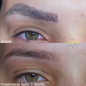 Junior Rodrigues - Remoção de Micropigmentação a Laser - Antes e Depois