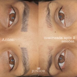 Junior Rodrigues - Remoção de Micropigmentação a Laser - Antes e Depois