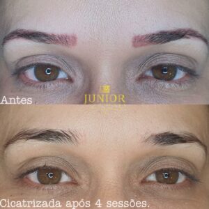 Junior Rodrigues - Remoção de Micropigmentação a Laser - Antes e Depois