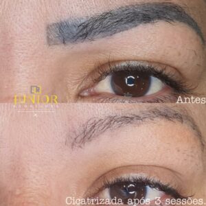 Junior Rodrigues - Remoção de Micropigmentação a Laser - Antes e Depois